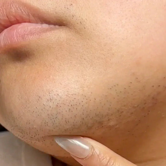 Hipertricose (excesso de pelos em todos os lugares) vs. Hirsutismo (pelos causados por hormônios)