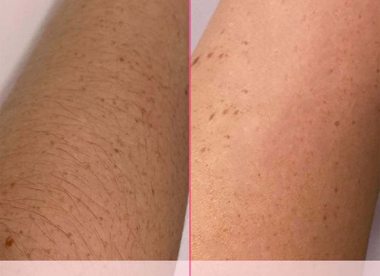 Depilação IPL: O que esperar antes e depois