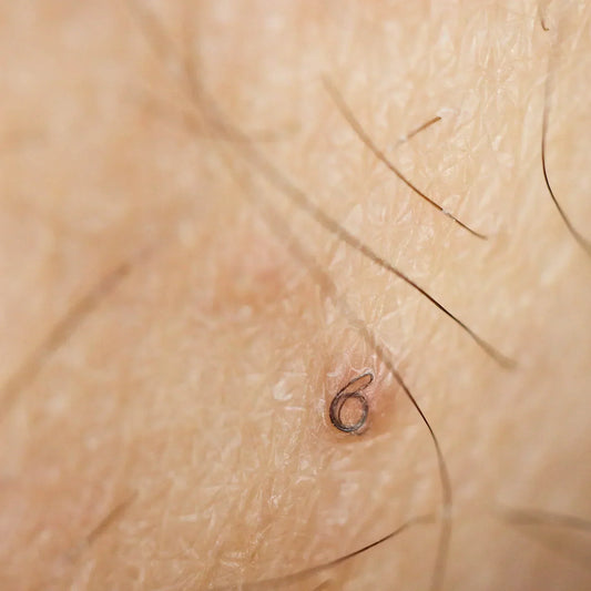 Como se livrar definitivamente dos pelos pubianos encravados... para sempre