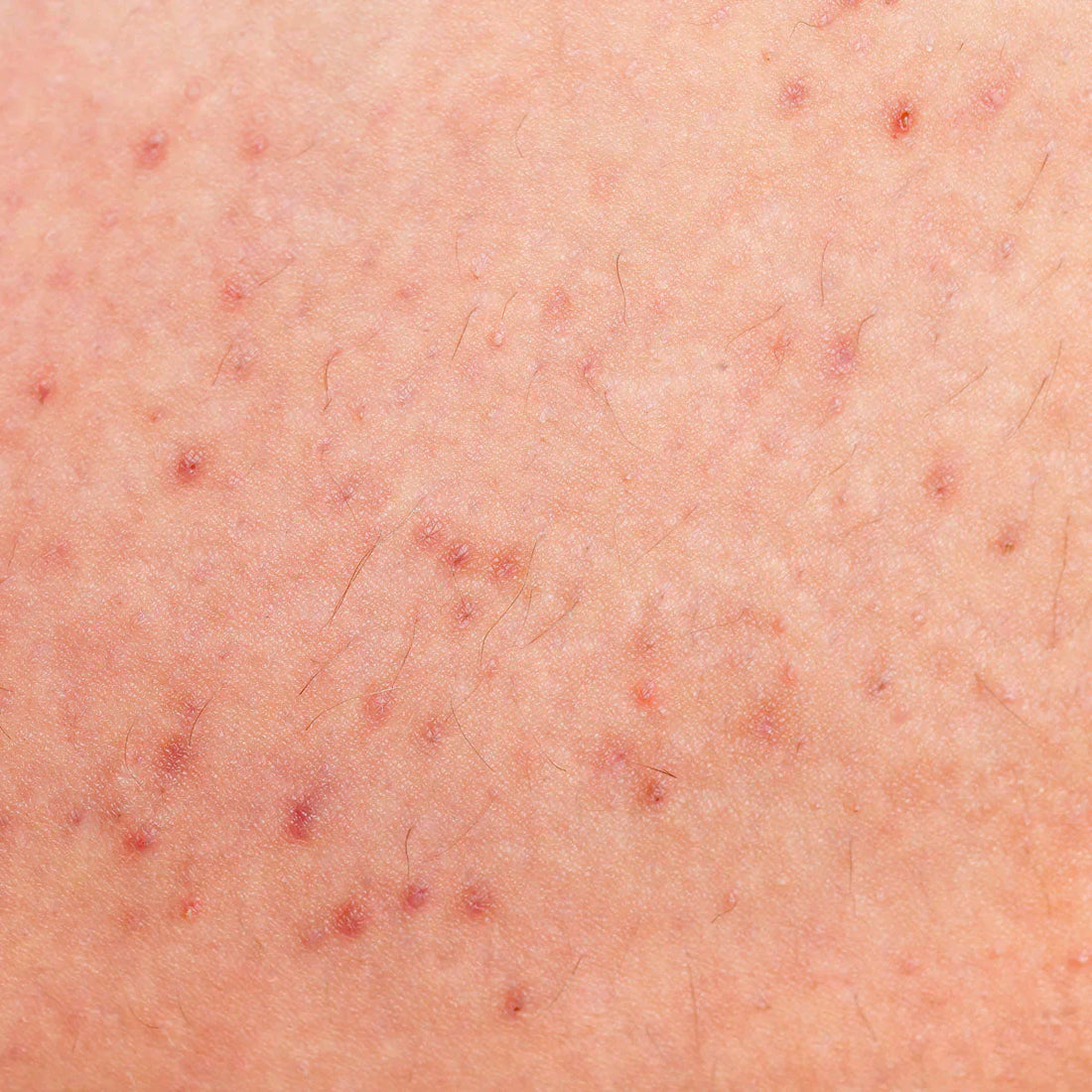 Como Prevenir Foliculite Após Depilação: O Guia Definitivo para uma Pele Lisa e Saudável
