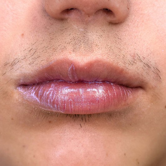 Por que a SOP causa crescimento excessivo de pelos faciais?