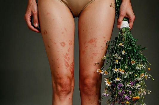 Pernas de Morango? Prevenção e Remédios Caseiros
