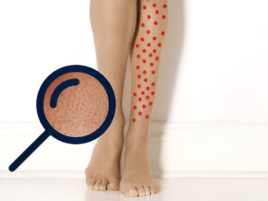 Pernas de Morango? Prevenção e Remédios Caseiros
